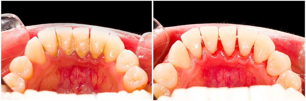 Zähne mit Zahnfleisch vor der Zahnreinigung (links) und nach der Zahnreinigung (rechts) wo der Zahnbelag entfernt wurde