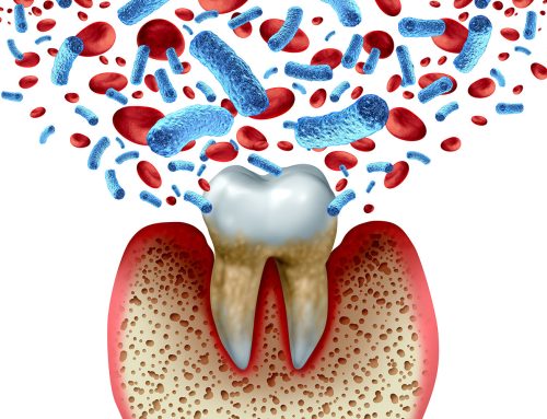 Ursachen von Knochenabbau um die Zähne bei entzündlichen Zahnfleischveränderungen (Parodontitis)