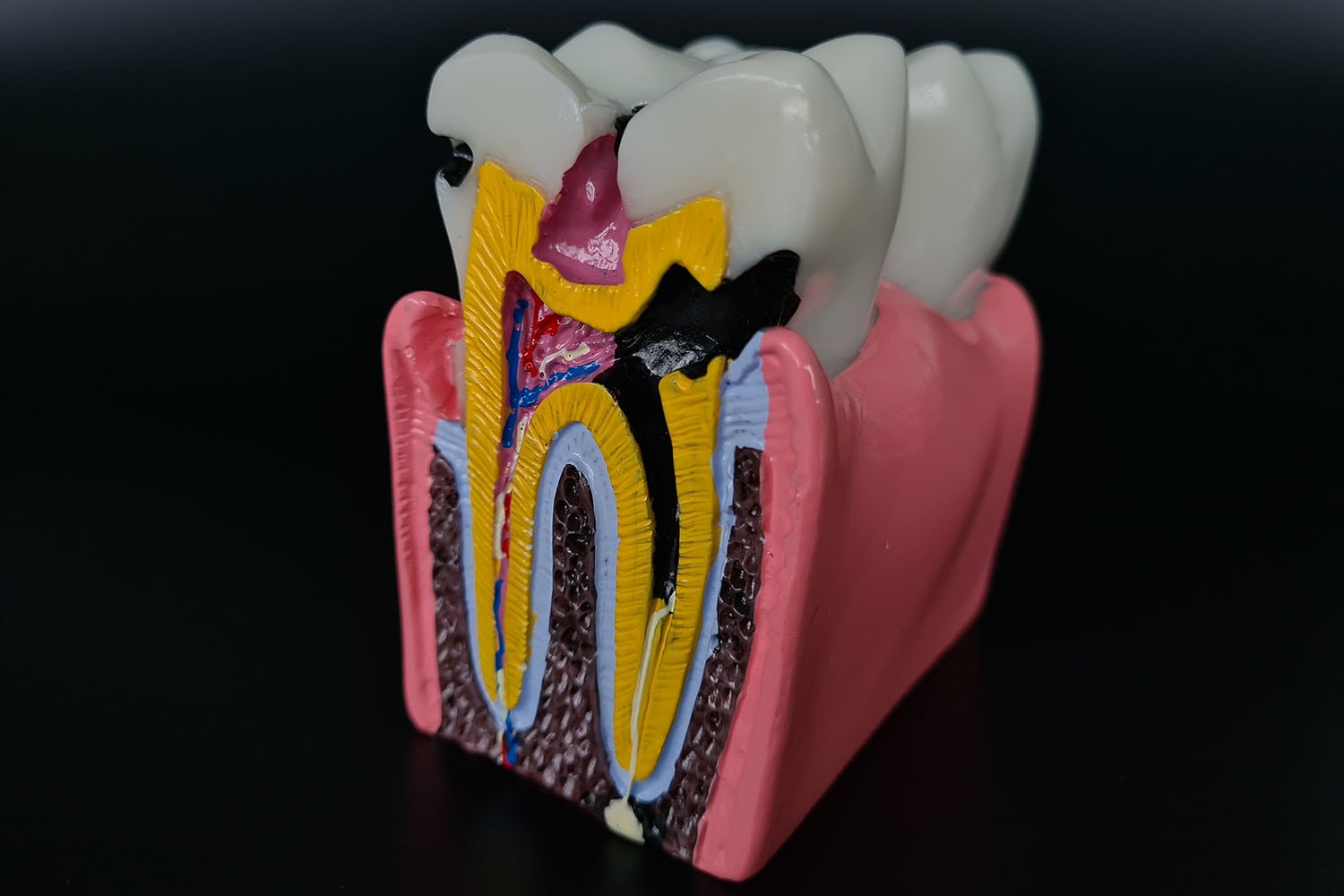 Process of root canal infection and tooth with caries.