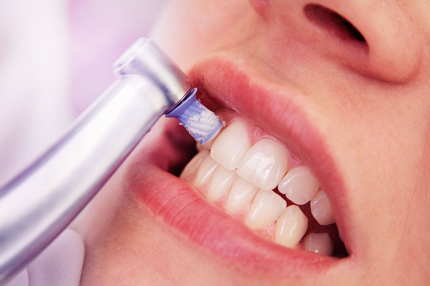 Close-up Professionelle Zahnreinigung / die Zähne einer Frau werden poliert.